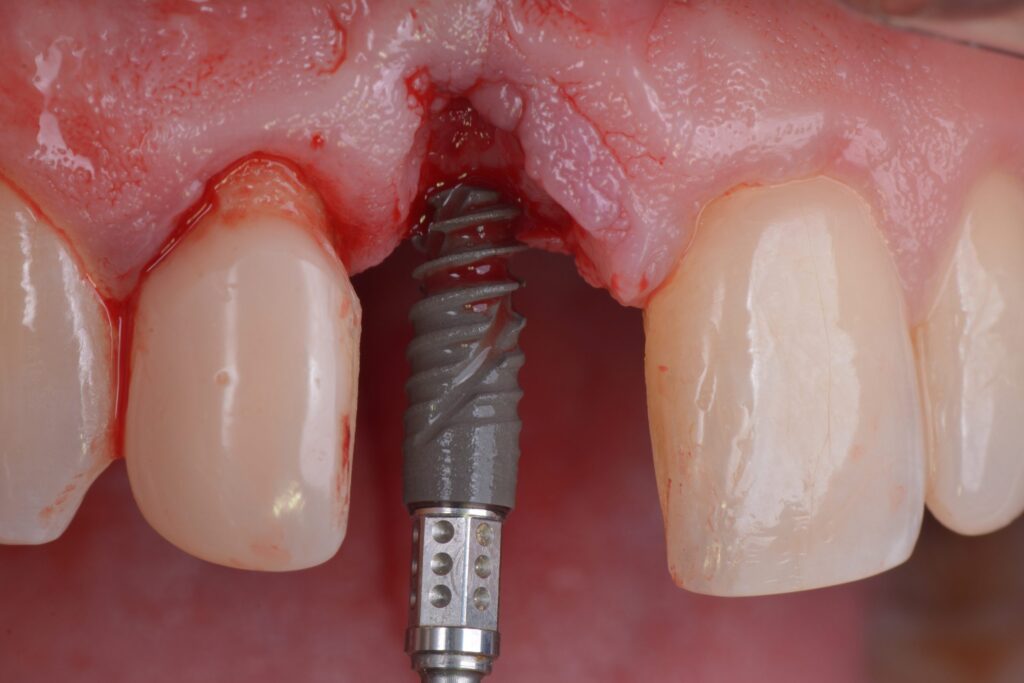 single dental implant