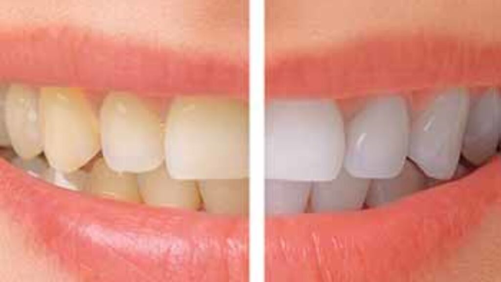 Small teeth bonding before and after