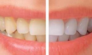 Small teeth bonding before and after
