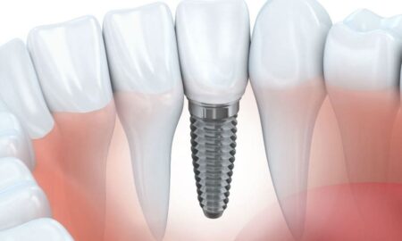dental bone grafting procedure